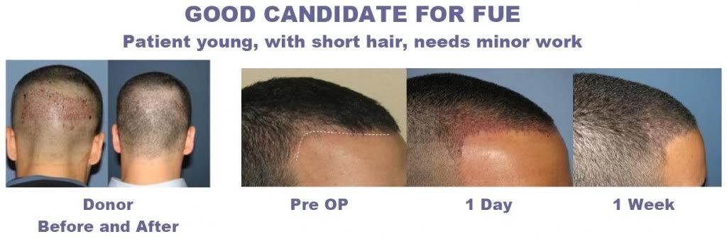 fue hair loss photos