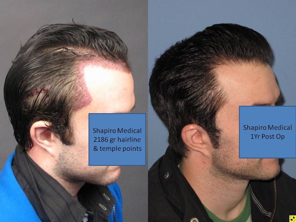 Temple Points Hair loss Forum Hair Transplant forums